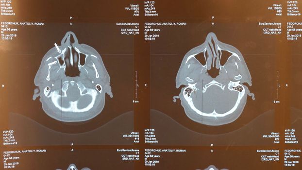 Magnetic resonance imaging of an older man's brain after a traumatic brain injury, which shows that the brain is damaged. Tomographic image of the head