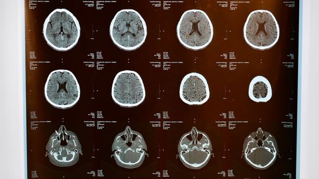 magnetic resonance imaging of the brain after a traumatic brain injury in an elderly male patient in the hospital, showing that the brain is affected