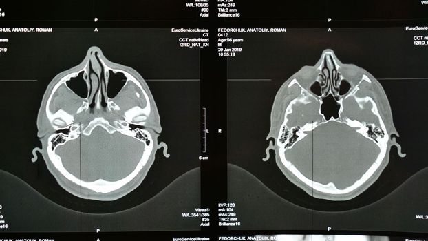 X-ray of the brain in case of head injury, stroke disease in an old adult. Magnetic resonance imaging, MRI close-up during examination by a doctor in a hospital. Examination by a neurologist