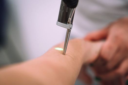 Close up shot of gloved hand with the laser hair removal machine's handpiece along woman hand. Alexandrite laser techhnology removing hair. Beauty procedureBeauty technology concept