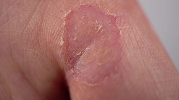 Male hand with callus on the finger close-up. Wart on hand. The skin of the hands lacks vitamins. Macro 4k