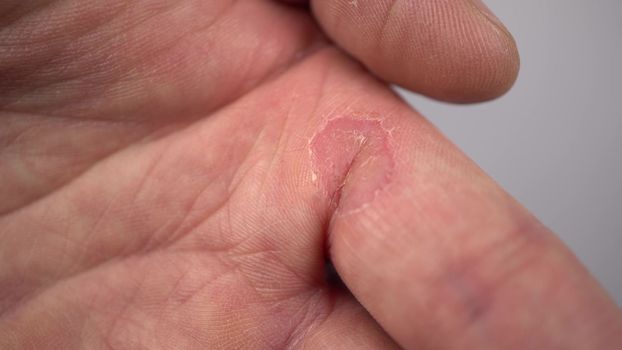 Wart on a man's finger closeup Large callus on the skin. 4k