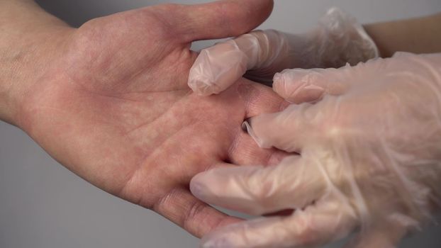 A doctor examines a fungal disease on a man's hand. Callus on the finger. Close-up hands. 4k