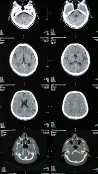 Magnetic resonance imaging, MRI of human brain after traumatic head injury, stroke, illness in elderly man in hospital. Examination by a neurologist, vertical