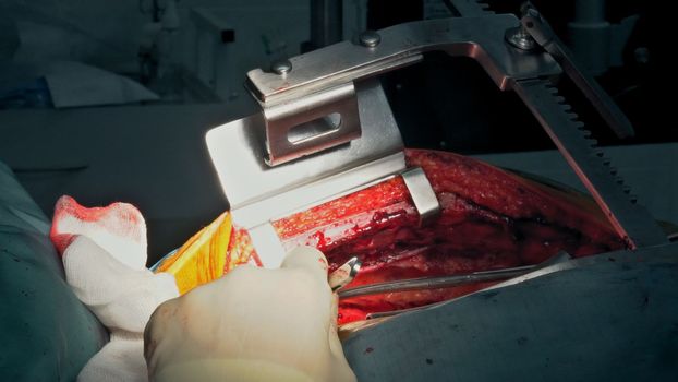 Coronary artery bypass graft CABG for heart operations due to disease coronary heart disease in hospital operation room