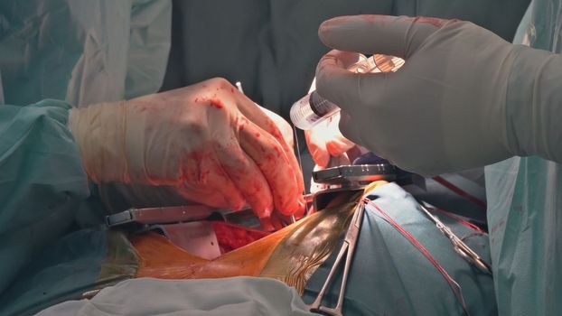 As part of heart operations due to coronary heart disease that are being performed in operating room hospital, coronary artery bypass grafts are being performed