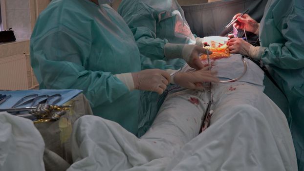 An operation room in hospital is where Coronary Artery Bypass Grafts CABG are performed as part of heart operations due to disease coronary heart disease