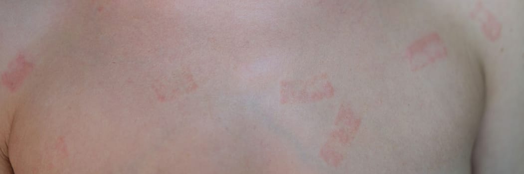 Red itchy patch rash on woman skin closeup. Diagnosis and treatment of contact dermatitis concept