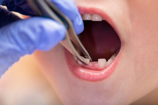 Children's teeth. The doctor extracts a child's tooth. Milk teeth in a child, close-up.