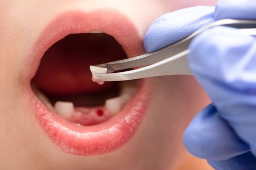 Removal of a milk tooth. The doctor pulled out a tooth from a child with tweezers. Extraction of a child's tooth with a dental instrument