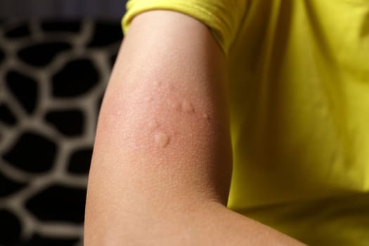 Allergy symptoms, after injection. Edematous part, red puncture site.