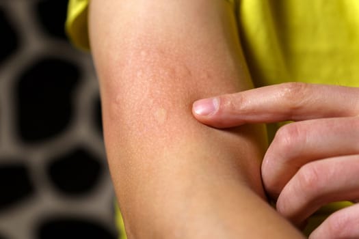 Allergy symptoms, after injection. Edematous part, red puncture site.