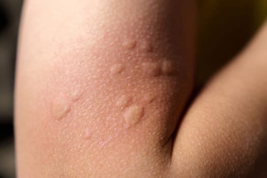 Allergy symptoms, after injection. Edematous part, red puncture site.
