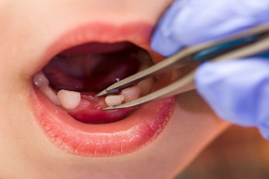 Children's teeth. The doctor extracts a child's tooth. Milk teeth in a child, close-up.