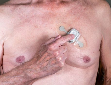 Morgantown, WV - 25 February 2023: Zio XT adhesive heart ECG monitor being activated by finger