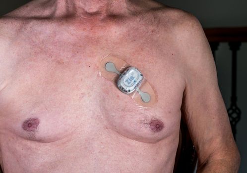 Morgantown, WV - 25 February 2023: Zio XT adhesive heart ECG monitor on male chest