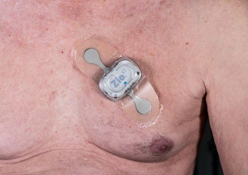 Morgantown, WV - 25 February 2023: Zio XT adhesive heart ECG monitor on male chest