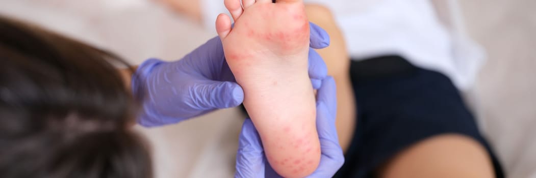 Doctor examines red rashes on feet of child. Enterovirus allergic rash and rash concept