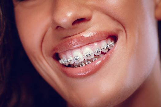 Close-up of a woman's white teeth with braces and smile. 