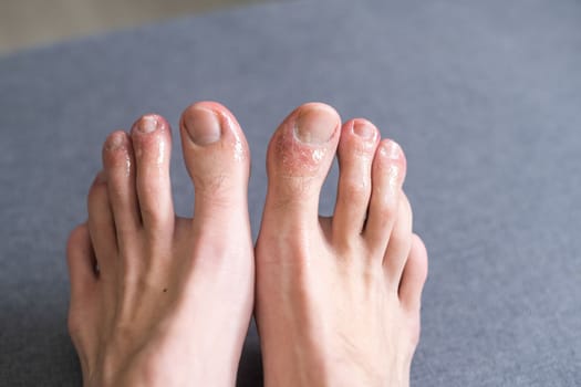 A white man holding his toes, showing what looks like a rash with red blotchy skin. A common side effect of Covid-19 often referred to as Covid toe.