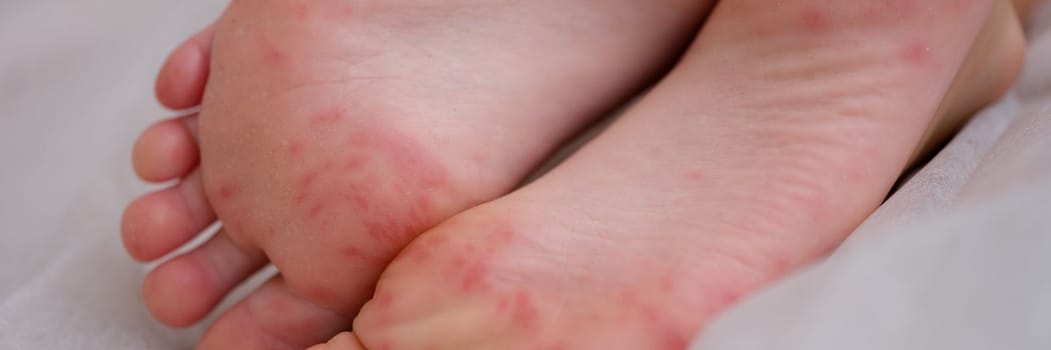 Painful rash red spots blisters on child leg. Children skin with eczema dermatitis and viral disease