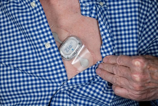 Morgantown, WV - 25 February 2023: Zio XT adhesive heart ECG monitor on male chest