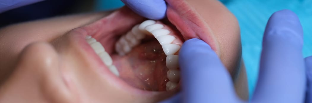 Doctor dentist examining patient oral cavity with veneers closeup. Installation of composite and zirconium veneers concept