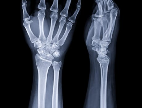 X-ray image of wrist joint for diagnosis rheumatoid arthritis .