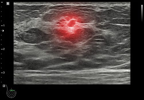 ultrasound breast of Patient after mammogram for diagnonsis Breast cancer in women isolated on black background.