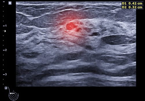 ultrasound breast of Patient after mammogram for diagnonsis Breast cancer in women isolated on black background.