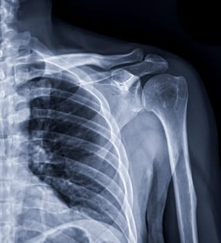 X-ray of Shoulder joint for diagnosis shoulder joint from dislocation or fracture.