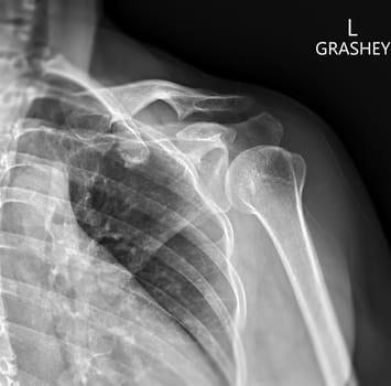 X-ray of Shoulder joint Grashey view for diagnosis shoulder joint from dislocation or fracture.