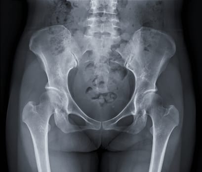 X-ray image of Pelvic bone.