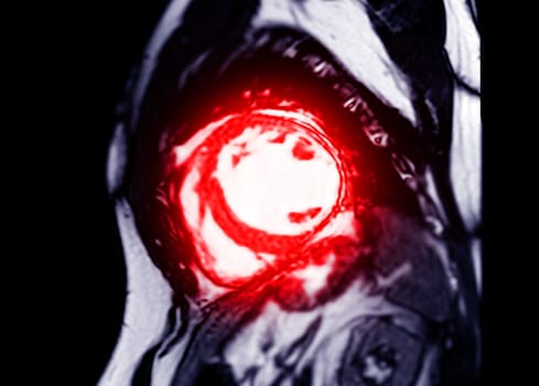MRI heart or Cardiac MRI in short axis view showing cross-sections of the left and right ventricle for diagnosis heart disease.