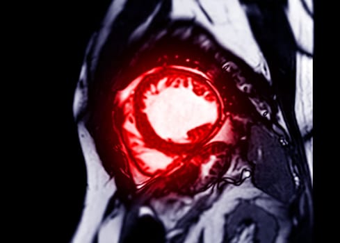 MRI heart or Cardiac MRI in short axis view showing cross-sections of the left and right ventricle for diagnosis heart disease.