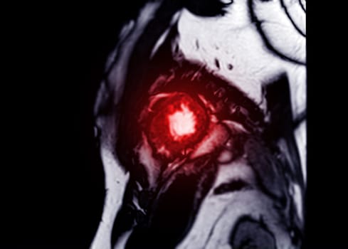 MRI heart or Cardiac MRI in short axis view showing cross-sections of the left and right ventricle for diagnosis heart disease.