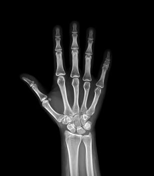 xray image of both hand AP view isolated on black background for diagnostic rheumatoid.