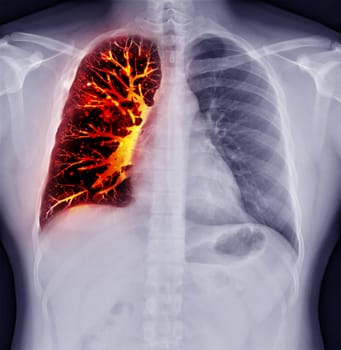 Fusion image of Chest x-ray and CT Chest Coronal view for lung infection from covid-19 Concept.