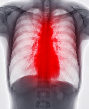 Chest x-ray image for screening diagnosis TB,tuberculosis and covid-19.