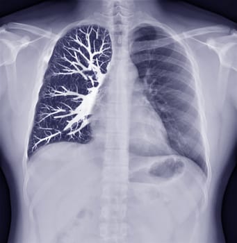 Fusion image of Chest x-ray and CT Chest Coronal view for lung infection from covid-19 Concept.