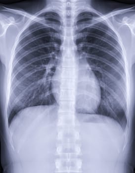 Chest x-ray image for screening diagnosis TB,tuberculosis and covid-19.