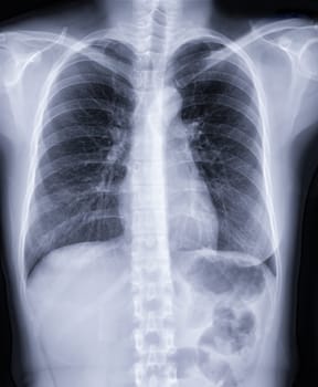 Chest x-ray image for screening diagnosis TB,tuberculosis and covid-19.