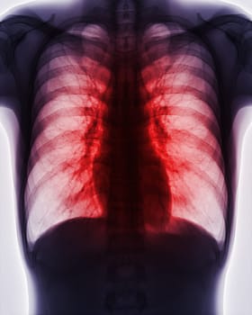 Chest x-ray image for screening diagnosis TB,tuberculosis and covid-19.