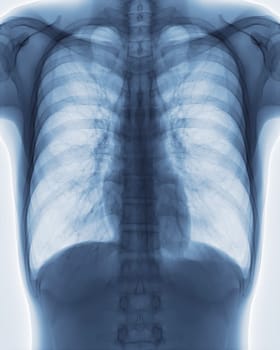 Chest x-ray image for screening diagnosis TB,tuberculosis and covid-19.