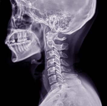 X-ray C-spine or x-ray image of Cervical spine lateral view for diagnostic intervertebral disc herniation and Spondylosis.