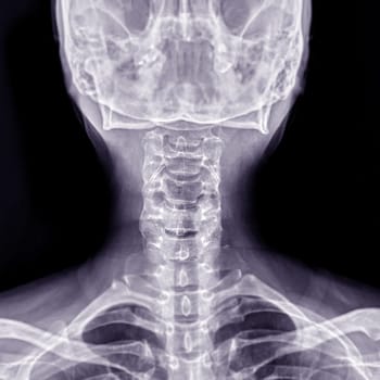 X-ray C-spine or x-ray image of Cervical spine AP view for diagnostic intervertebral disc herniation and Spondylosis.