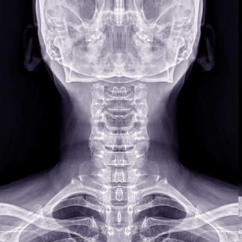 X-ray C-spine or x-ray image of Cervical spine AP view for diagnostic intervertebral disc herniation and Spondylosis.