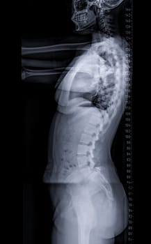 X-ray image of Whole Spine for diagnosis scoliosis of spine.