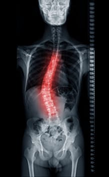 X-ray image of Whole Spine for diagnosis scoliosis of spine.