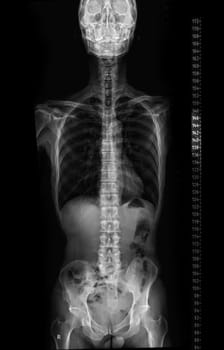 X-ray image of Whole Spine for diagnosis scoliosis of spine.